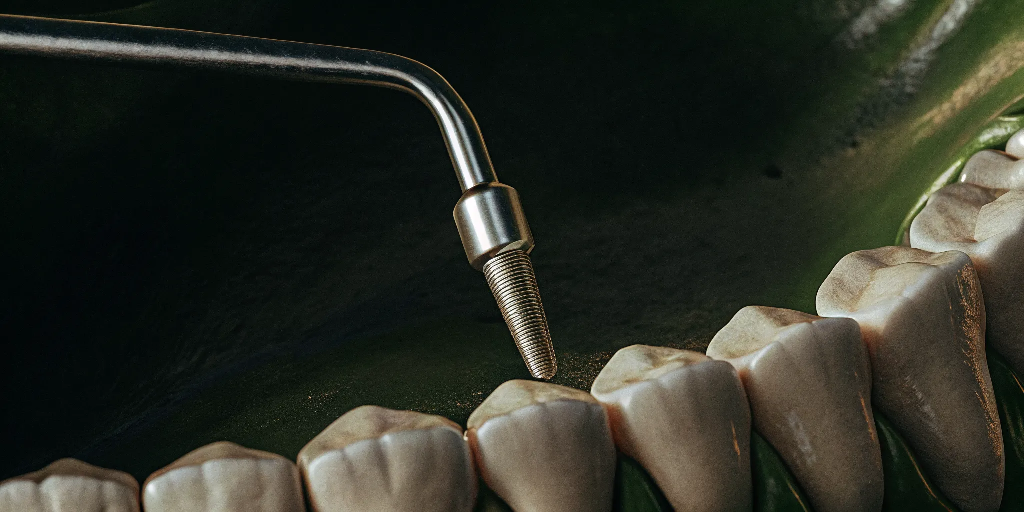 A bone graft being placed into the socket after a tooth extraction.