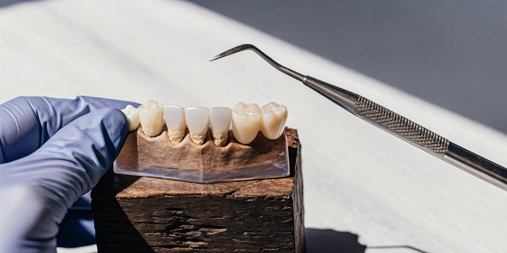 A model of a dental bridge held in a gloved hand, showing how it replaces a missing tooth.